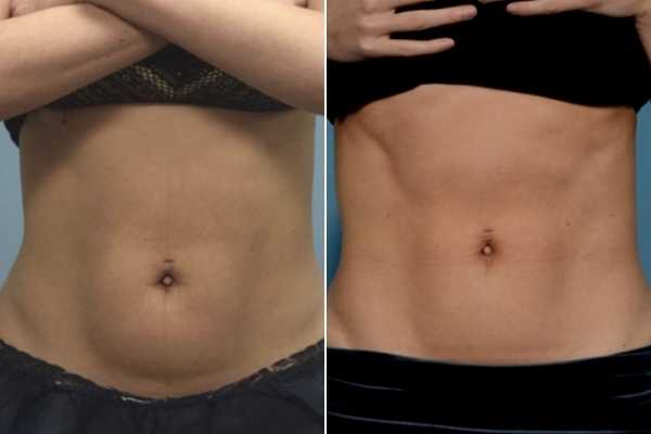 body sculpting FAQs Croydon