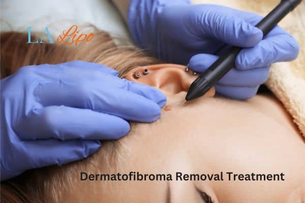Dermatofibroma Removal Treatment Croydon