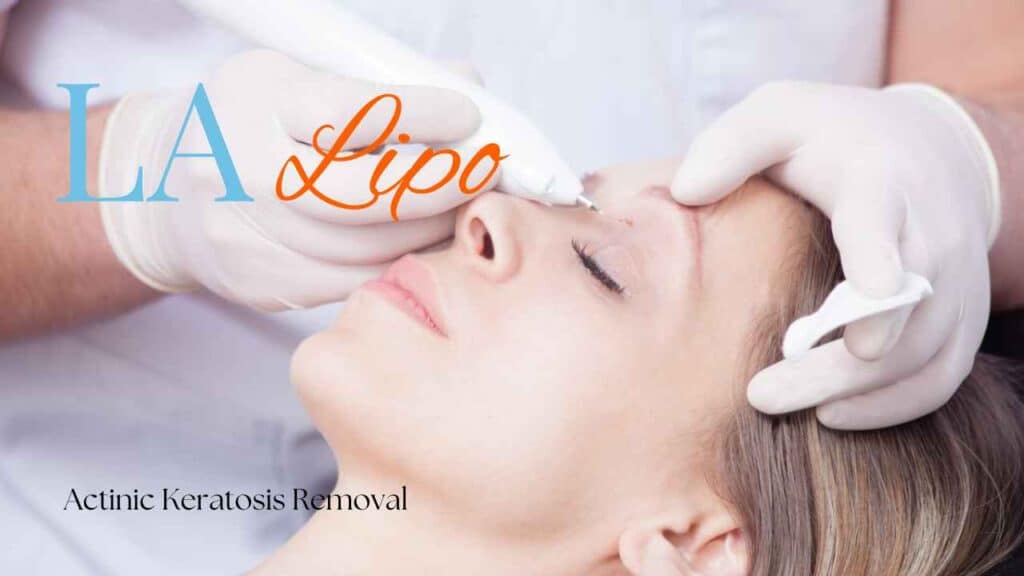 actinic keratosis removal Croydon