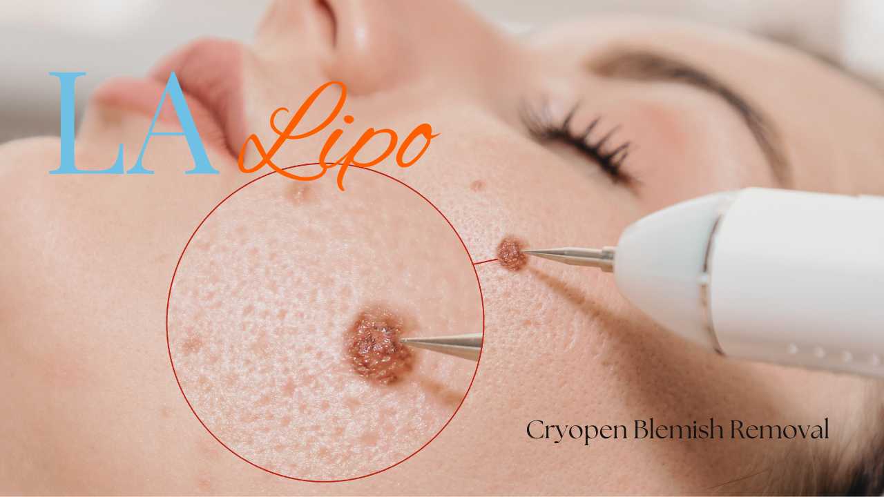 cryopen blemish removal Croydon Contact our team today!