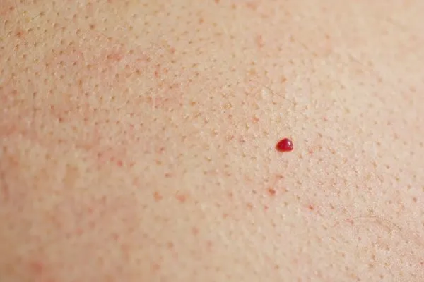 close up of a cherry angioma Croydon