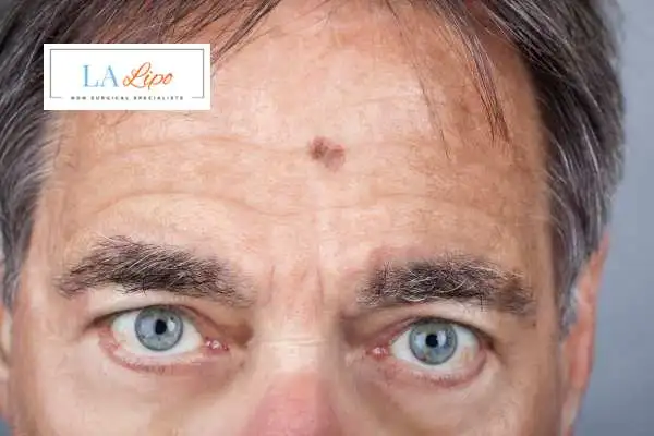Solar Lentigo Removal Croydon image of man with mark on his forehead
