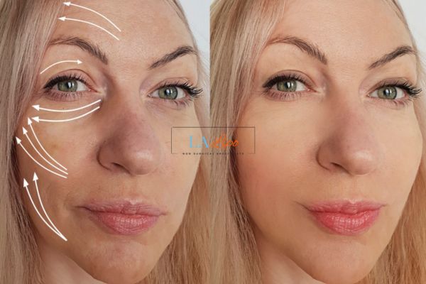 Morpheus 8 results Croydon face lift.