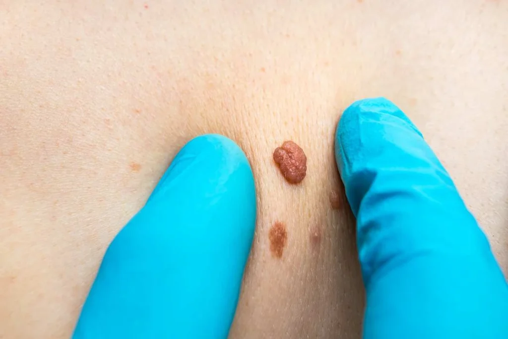 LA LIPO Cryopen Lesion Removal Prices Croydon